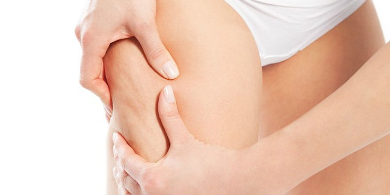 celulitis problema