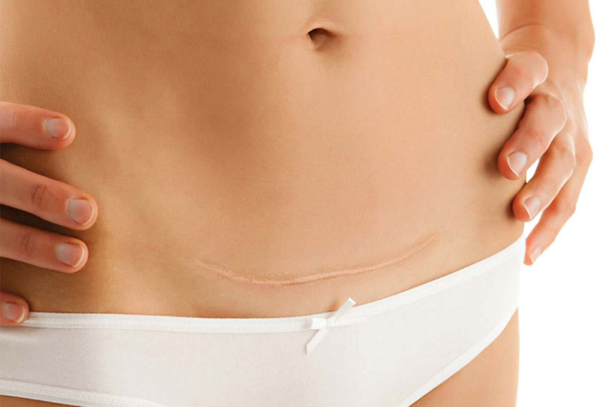 abdominoplastia tras embarazo cesarea (1) cesárea