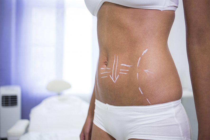 una-abdominoplastia-1 una abdominoplastia