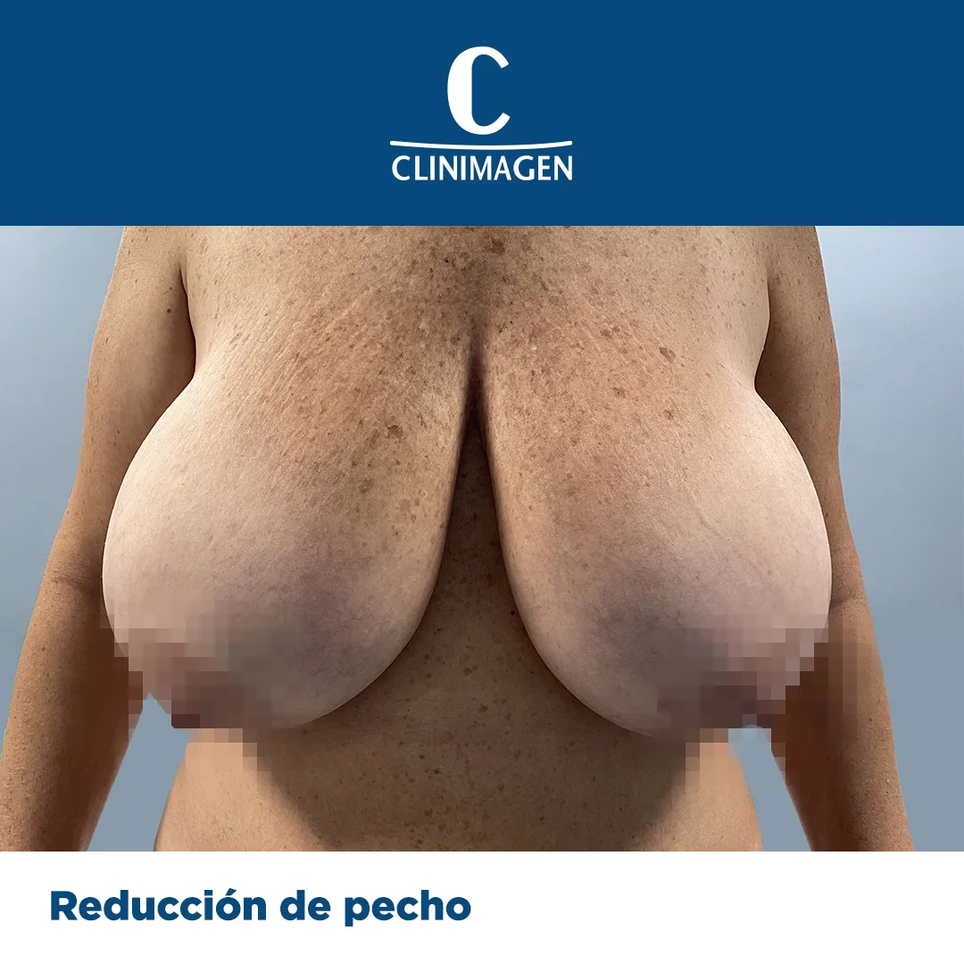 reduccion de pecho