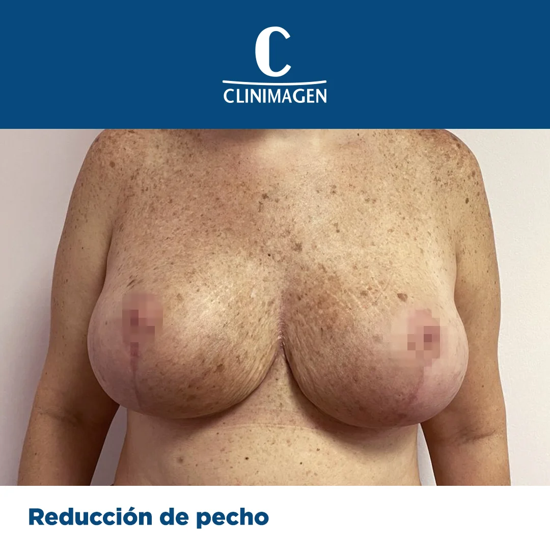 reduccion de pecho