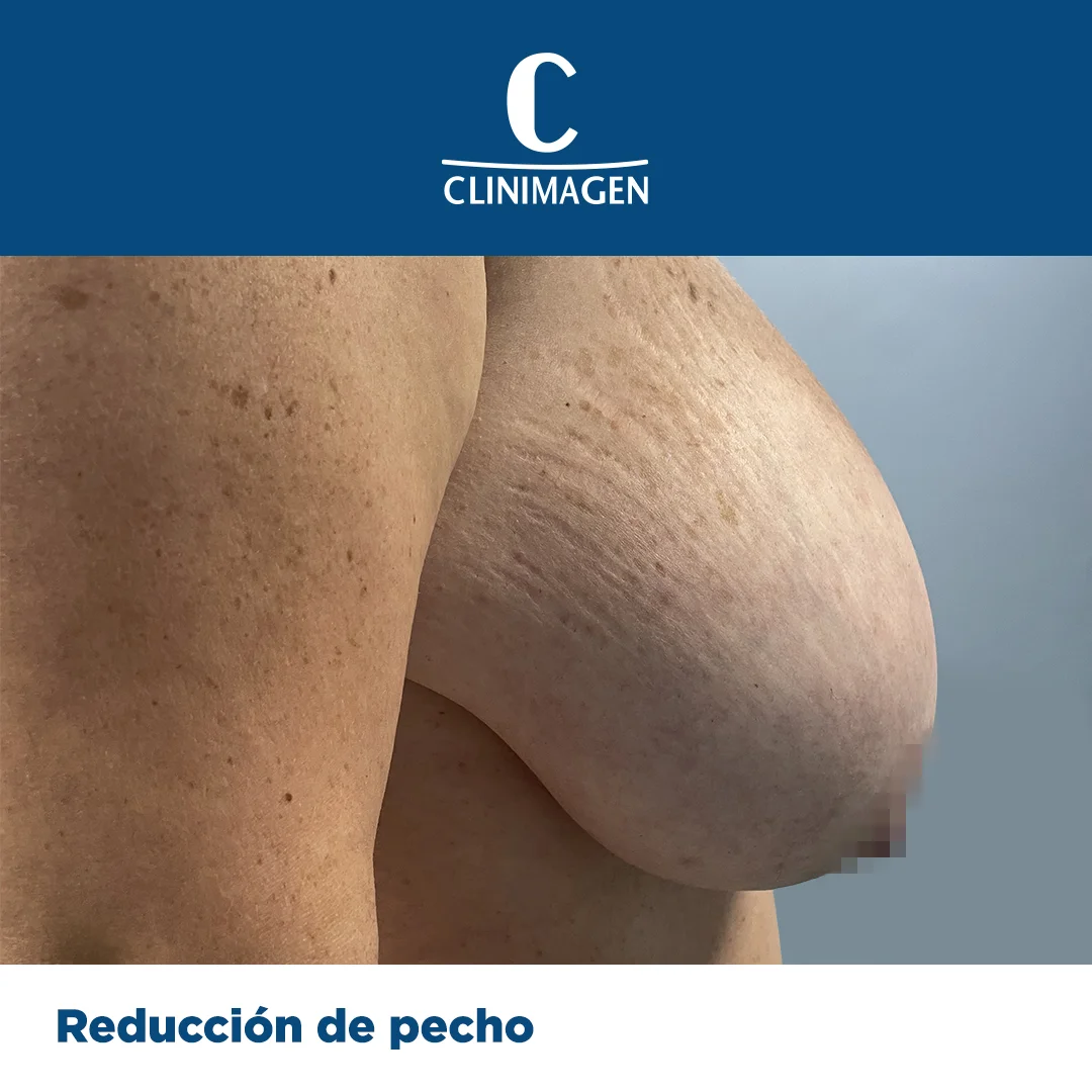 reduccion de pecho