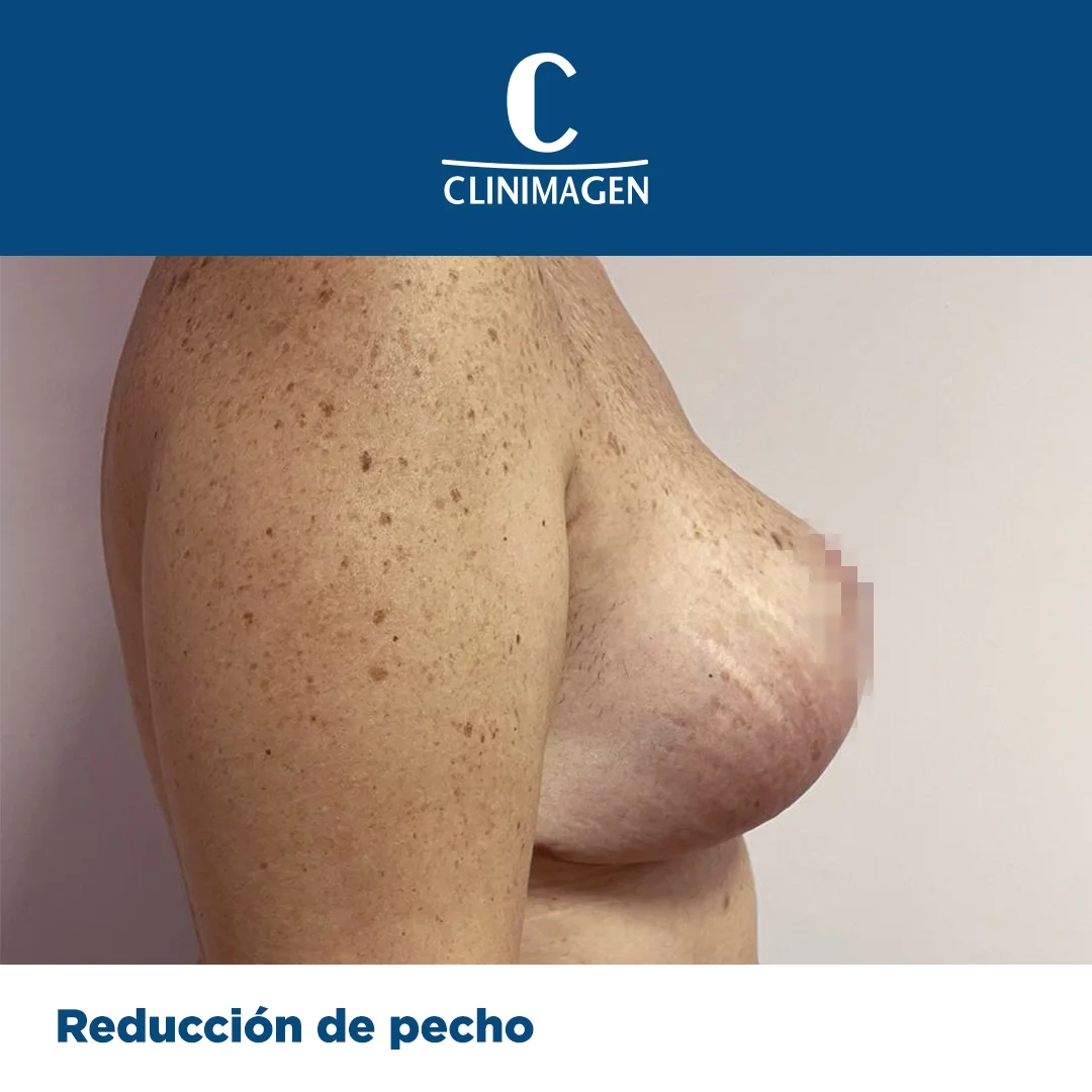 reduccion de pecho