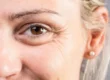 blefaroplastia cirugía de párpados