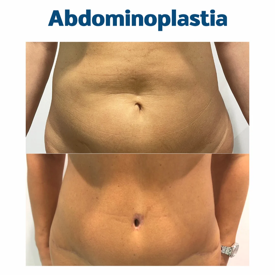 abdominoplastia antes-despues