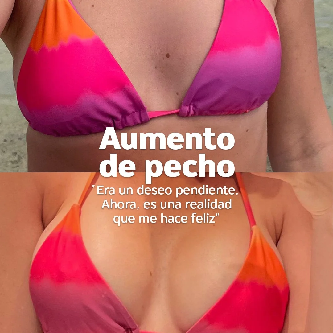 aumento de pecho casos