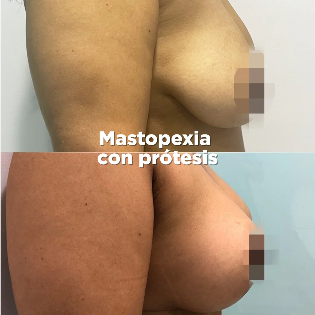 mastopexia antes-después