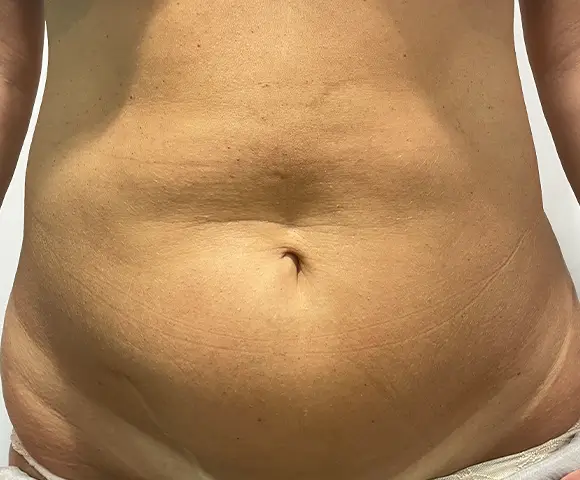 Antes de una intervención de abdomen