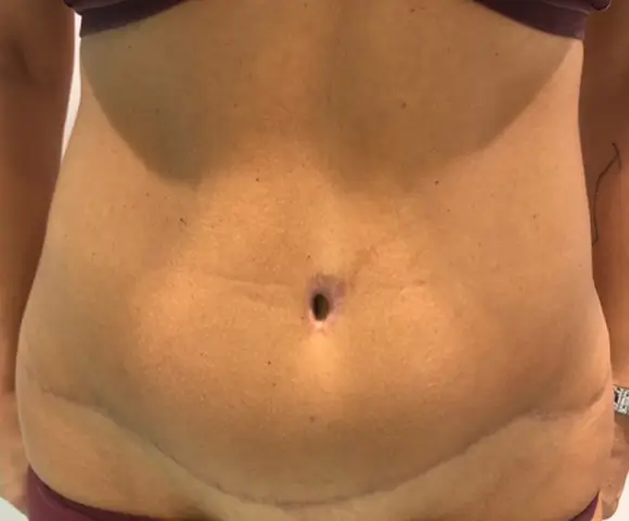 Después de una intervención de abdomen